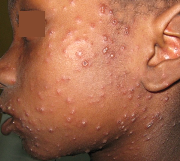 Some appearances of chickenpox may look like bumps on your face