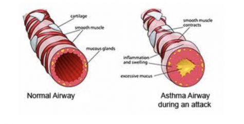Dealing with asthma